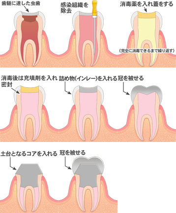 虫歯の治療の流れ