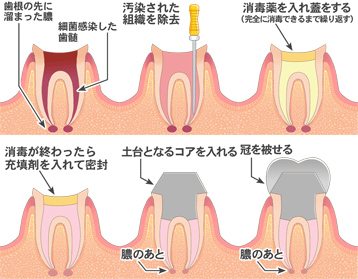 虫歯の治療の流れ