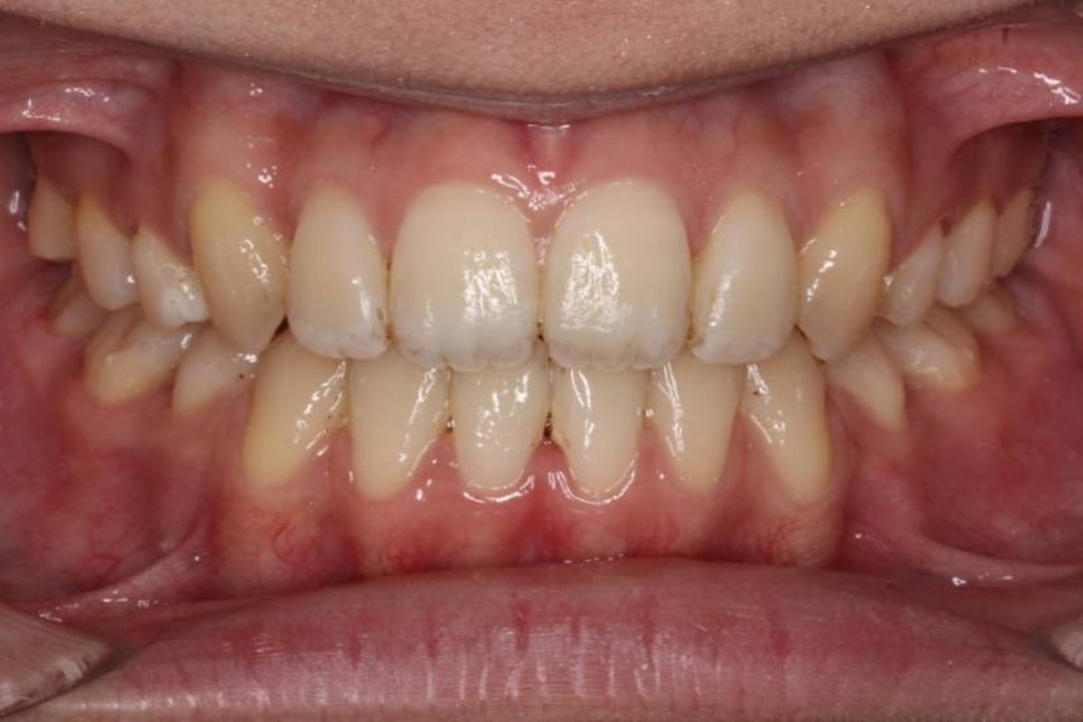 6. 永久歯の本格矯正治療